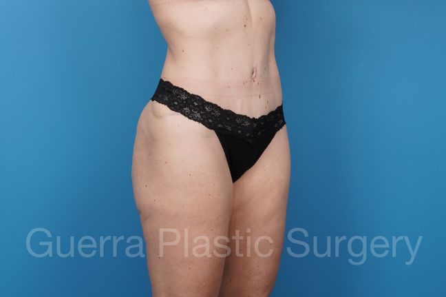 After Photo 5