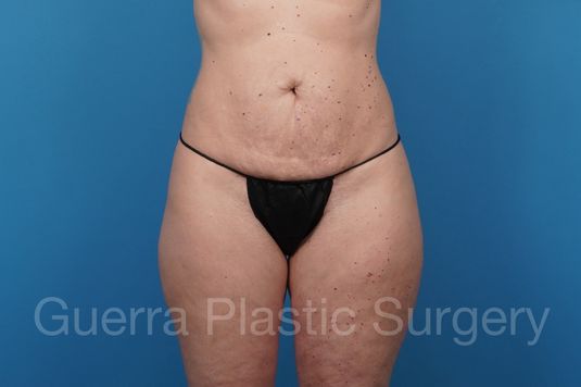 prev Case #43613 Before