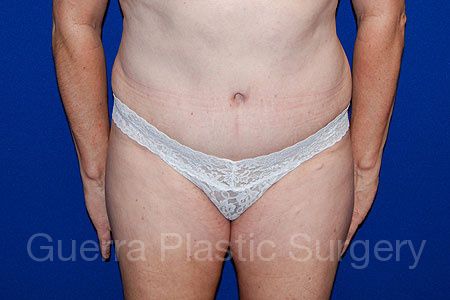 next Case #30139 After