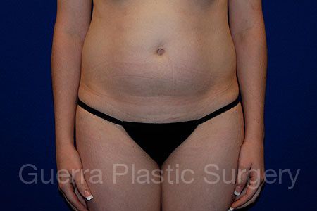 Case #144889 Before