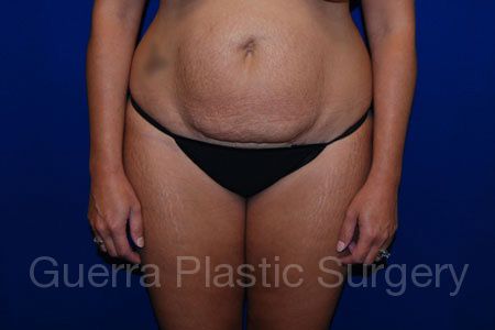 Case #31637 Before