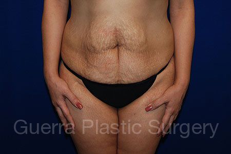 Case #26354 Before