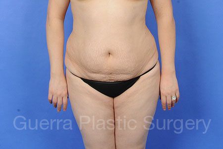 Case #34017 Before