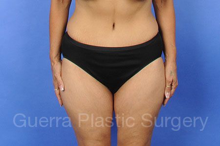next Case #30215 After