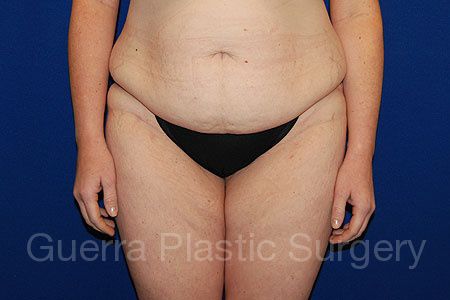 Case #12539 Before
