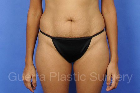 Case #30454 Before