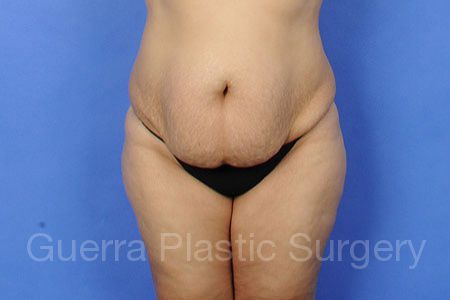 Case #30889 Before