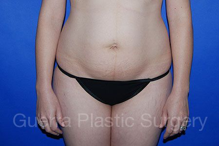 Before Photo Tummy Tuck