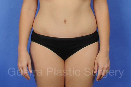 After Photo Tummy Tuck
