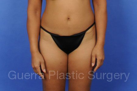 Before Photo Tummy Tuck