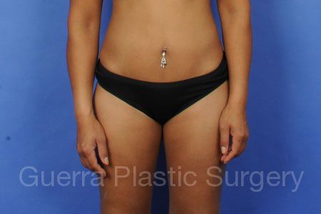 After Photo Tummy Tuck