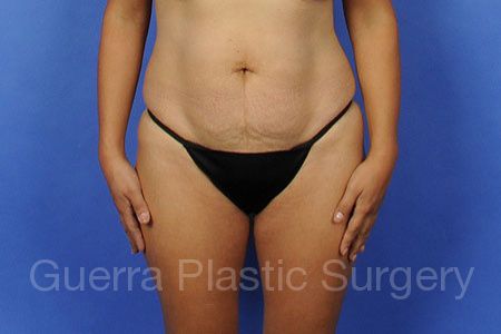 Case #304982 Before