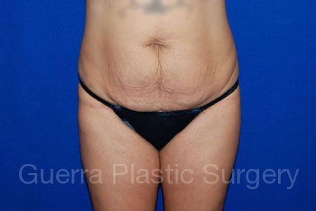 Case #30972 Before