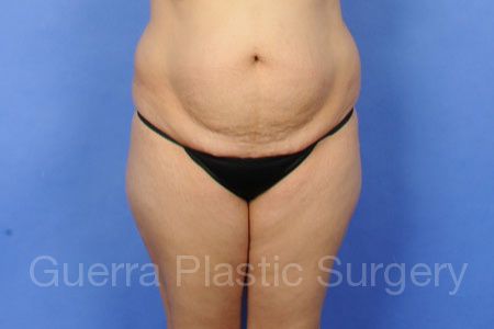 Case #309472 Before