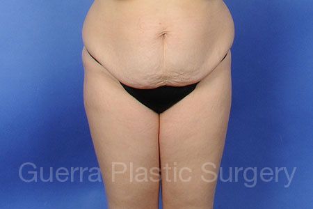 Case #309552 Before