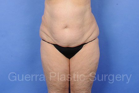 Case #31902 Before