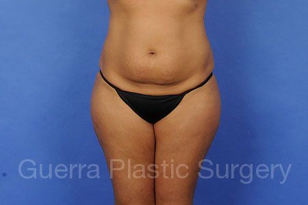 Case #301172 Before