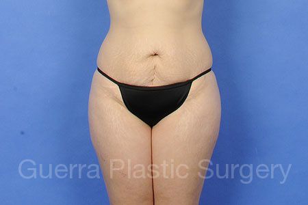 Case #308352 Before