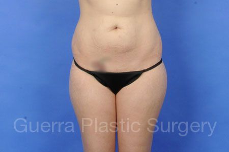 Case #318272 Before
