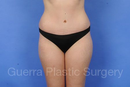 Case #318272 After