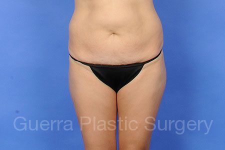 Before Photo Tummy Tuck
