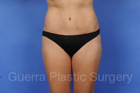 After Photo Tummy Tuck