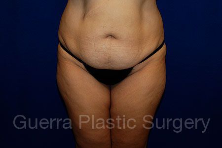 Case #68533 Before