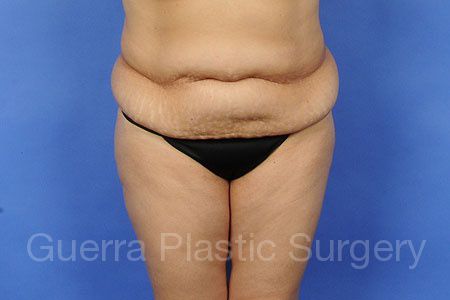 Case #78235 Before