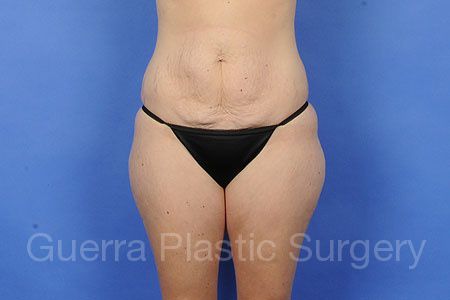 Case #65822 Before
