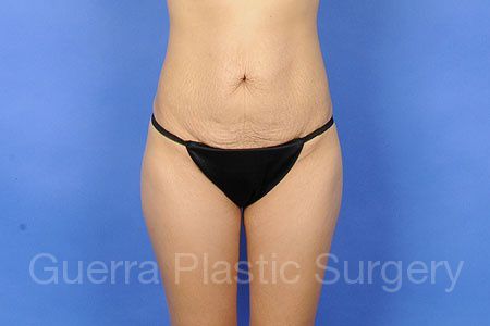 Case #33655 Before