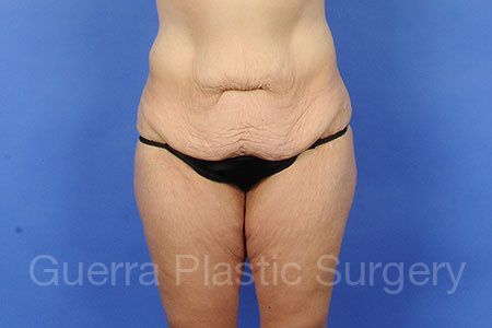 Case #35628 Before