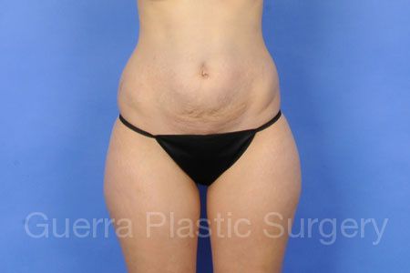 Case #97412 Before