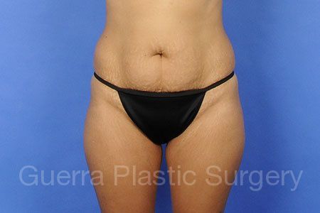 Case #58247 Before