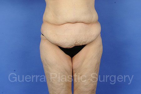 Case #49732 Before