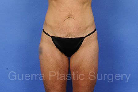 Case #54781 Before