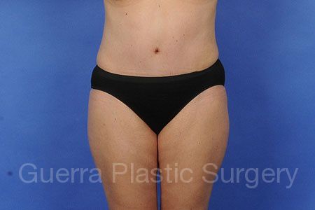 prev Case #55441 After