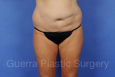 Case #93868 Before
