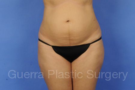 Case #33698 Before