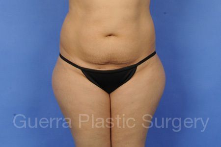 Case #38965 Before