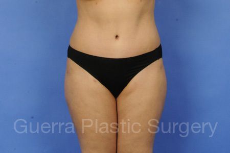 Case #38965 After
