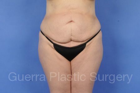 Case #33369 Before