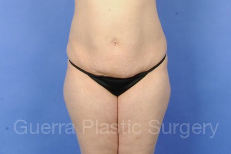 Case #36977 Before