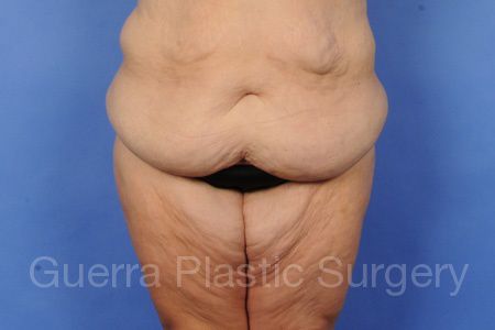 Case #21587 Before