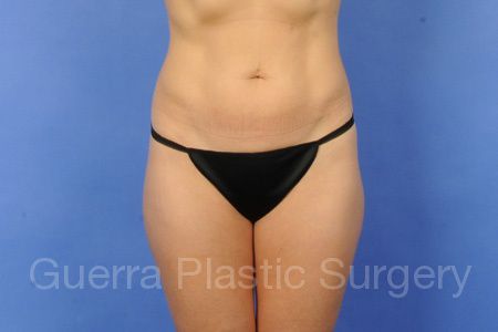Case #11554 Before