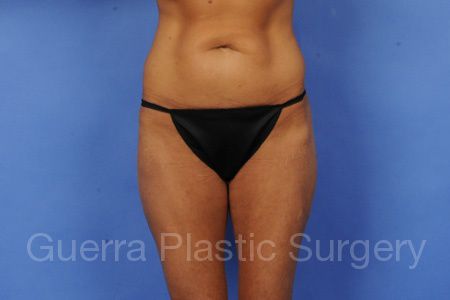 Case #87965 Before