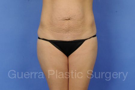 Case #55876 Before