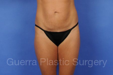 Case #95135 Before