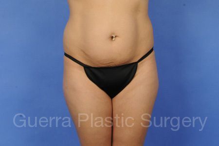 Case #65789 Before