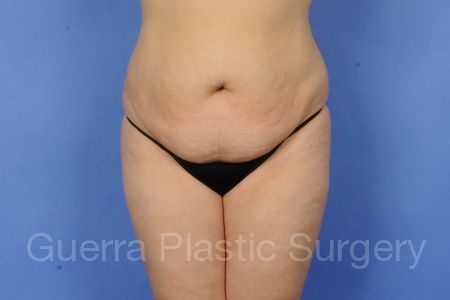 next Case #99689 Before