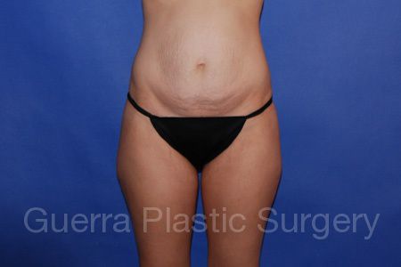 Case #45789 Before